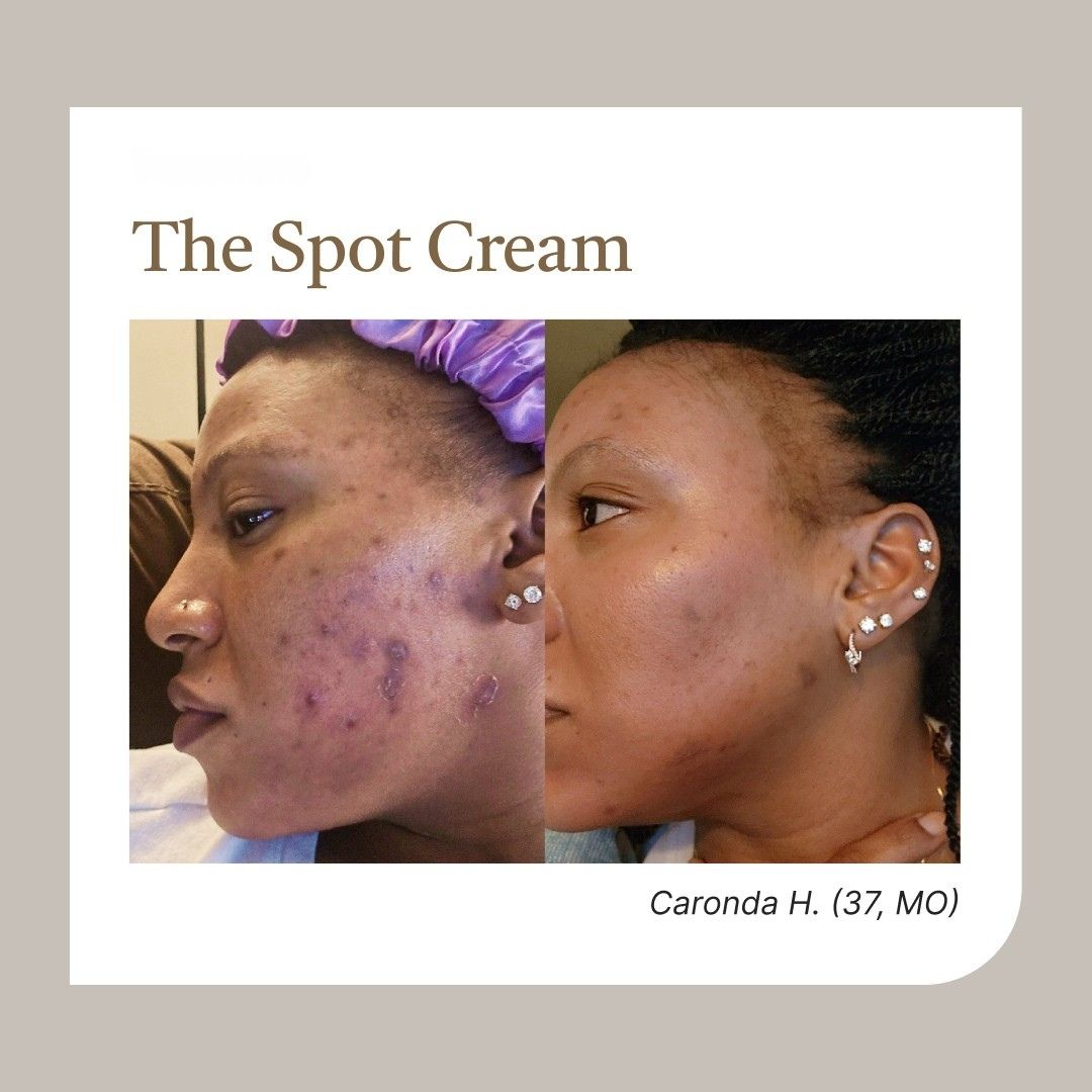 ✨Musely "The Spot Cream": Adiós melasma, hola piel radiante.
